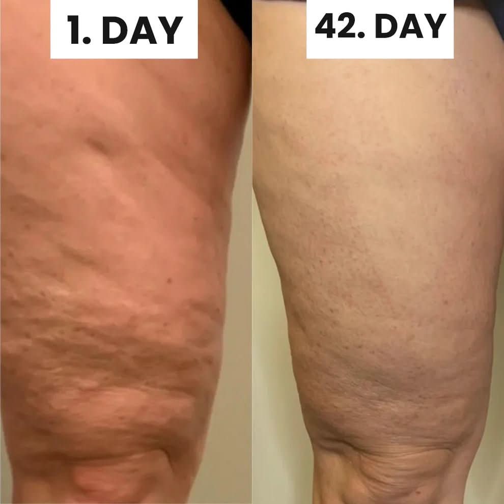 Anti-Cellulite Massager